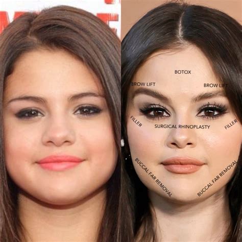 selena gomez boobs before and after|Selena Gomez Breast Implant Plastic Surgery Before And After。